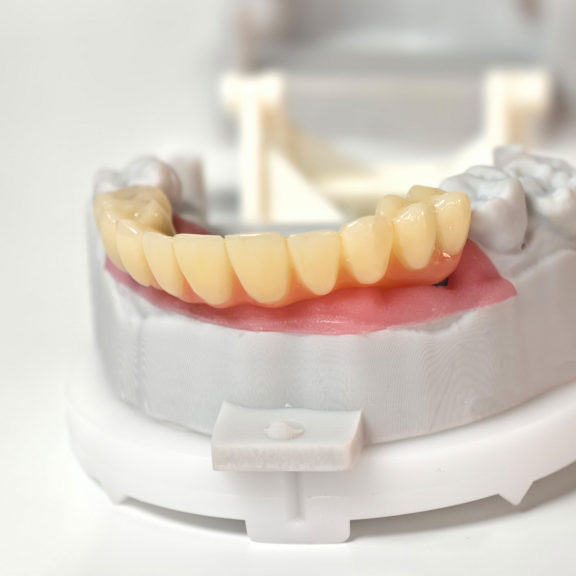PMMA Bridge With Screw Retained
