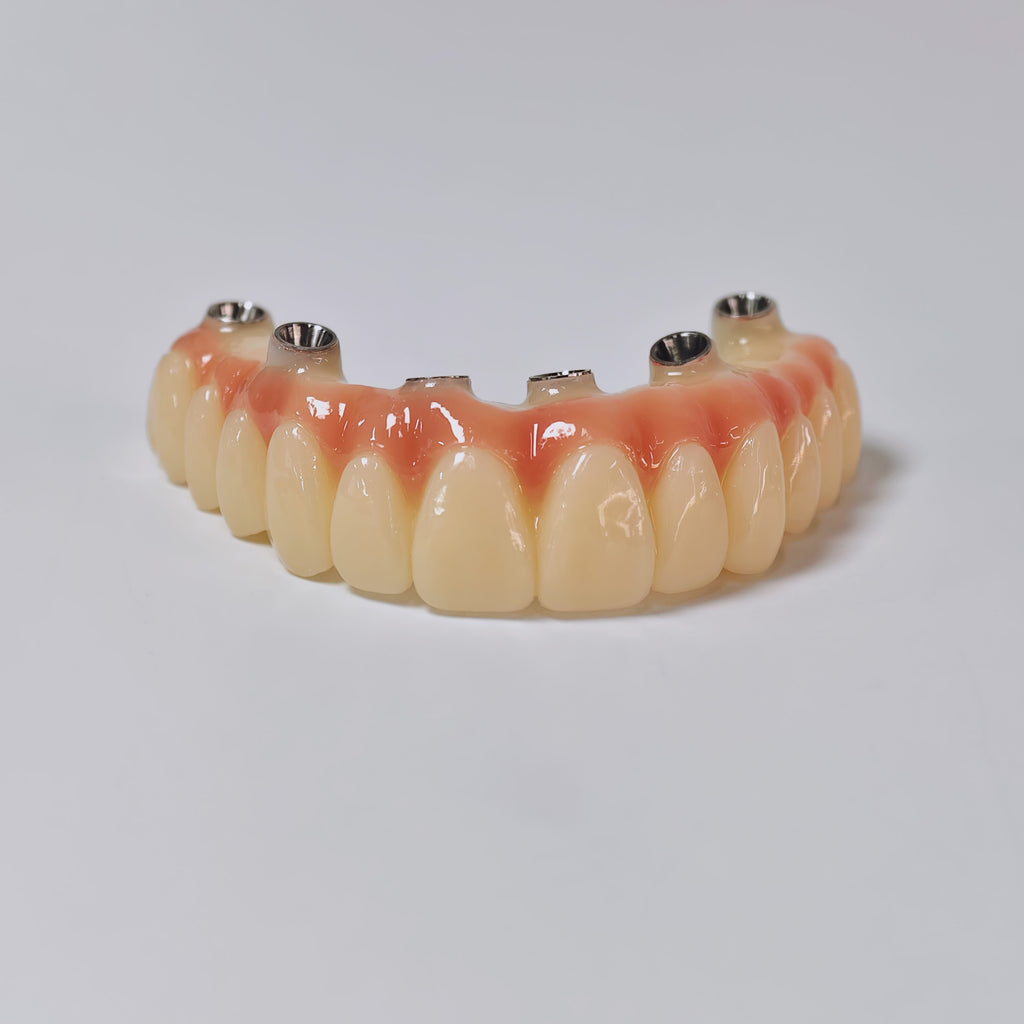 PMMA Bridge With Screw Retained
