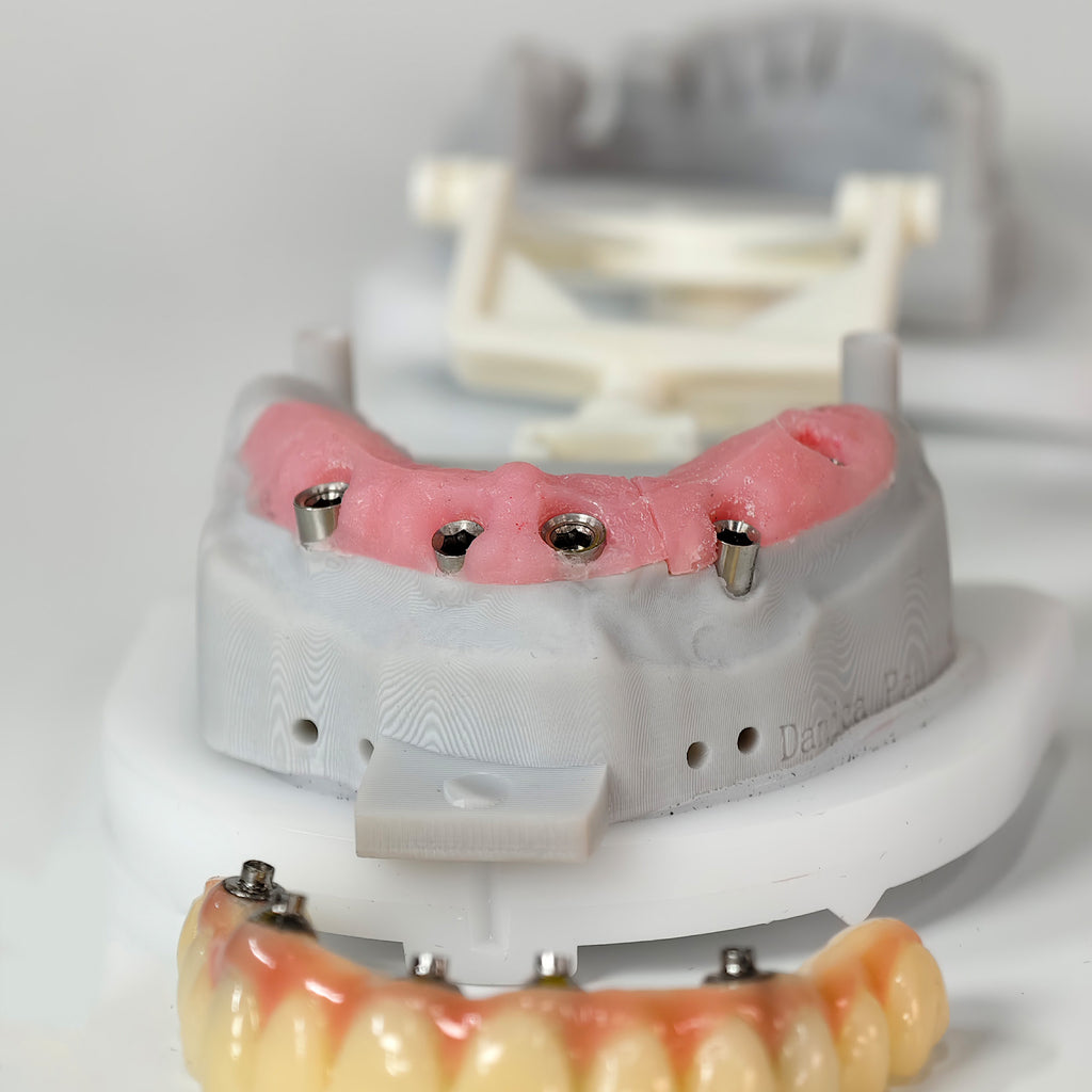 PMMA Bridge With Screw Retained