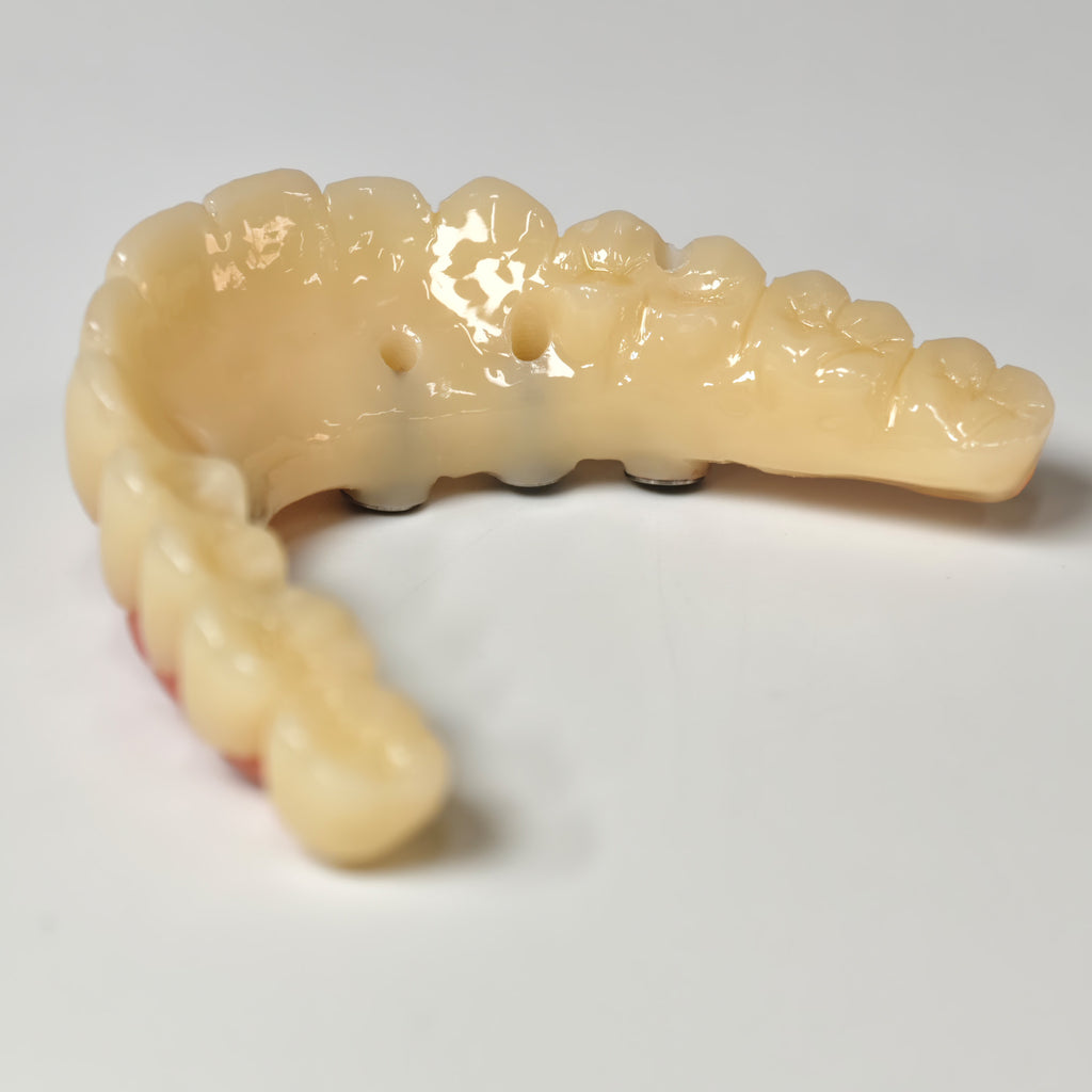 PMMA Bridge With Screw Retained
