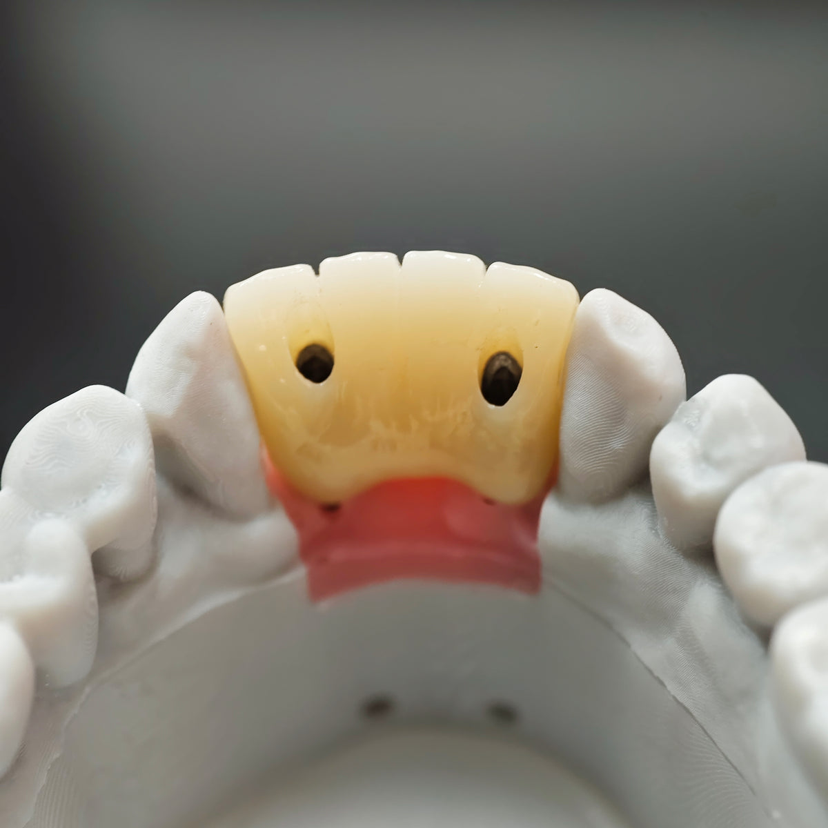 Ti-Bar Titanium Nitride Metal Frame With Zirconia Bridge For Full Arch Restoration