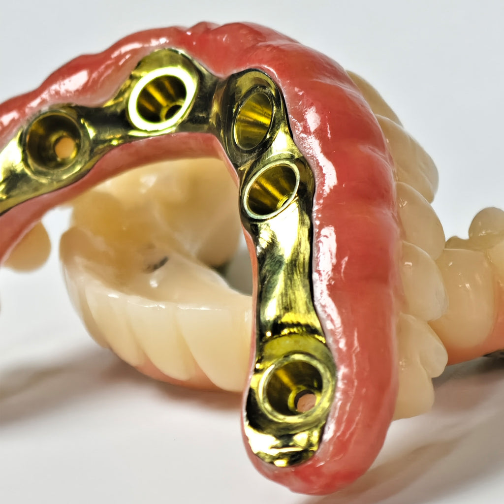Ti-Bar Titanium Nitride Metal Frame With Zirconia Bridge For Full Arch Restoration