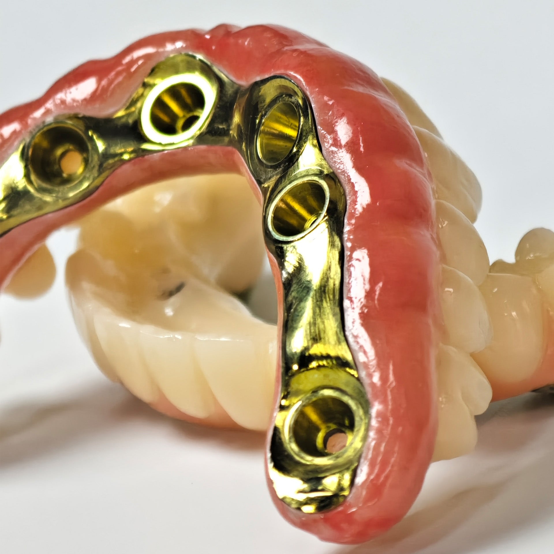 Ti-Bar Titanium Nitride Metal Frame With Zirconia Bridge For Full Arch Restoration