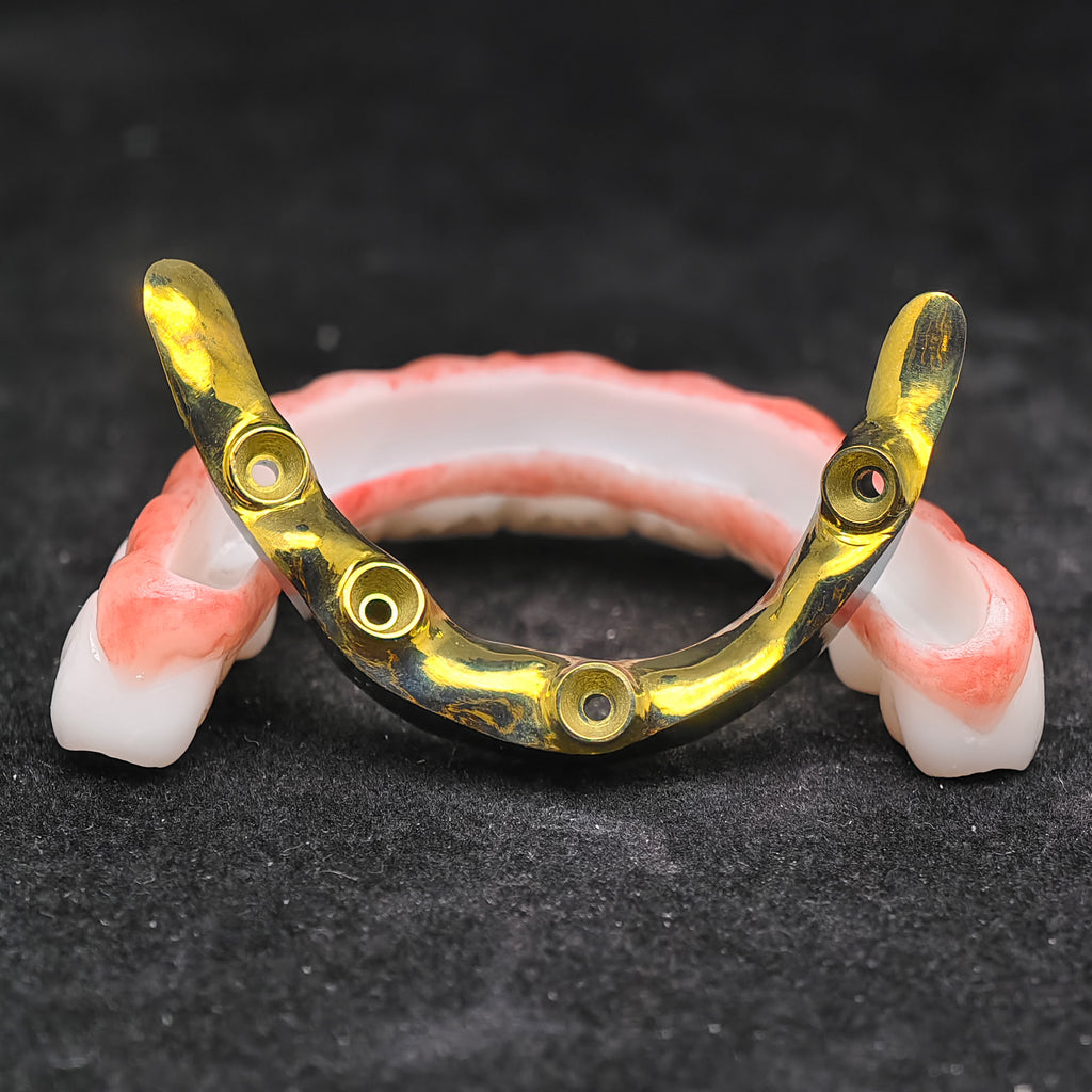 Ti-Bar Titanium Nitride Metal Frame With Zirconia Bridge For Full Arch Restoration