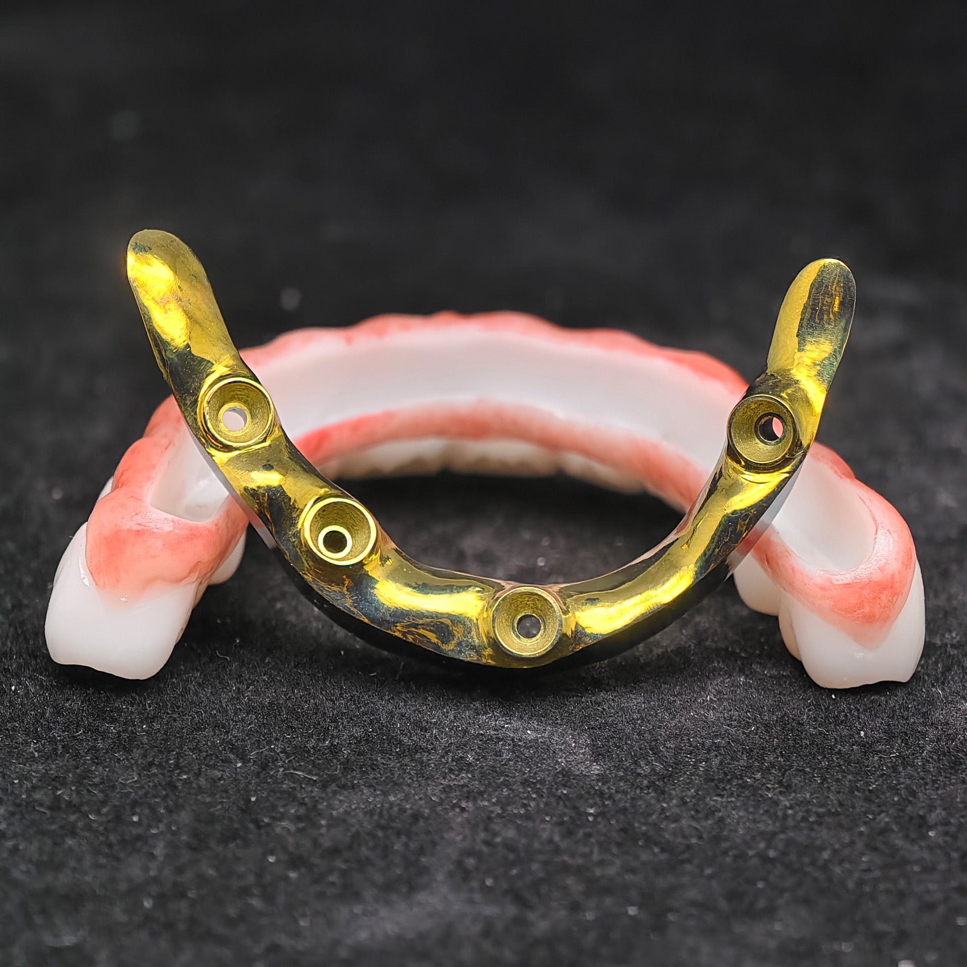 Ti-Bar Titanium Nitride Metal Frame With Zirconia Bridge For Full Arch Restoration