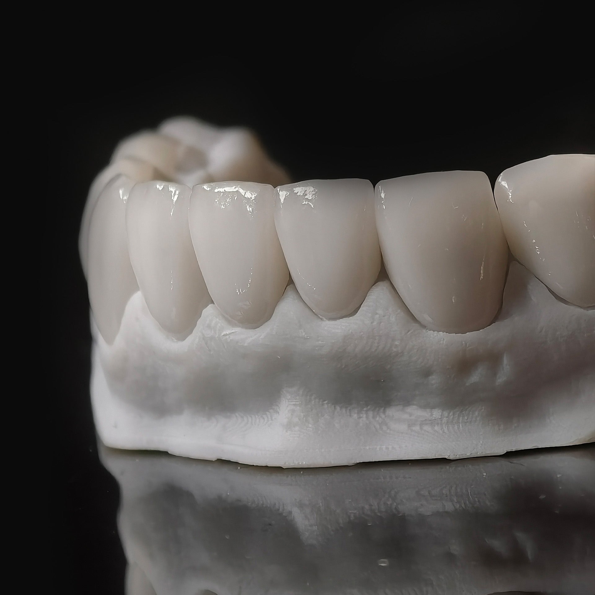 Ultra-Thin Emax Veneer. High Transparency/Translucent, Natural Shade