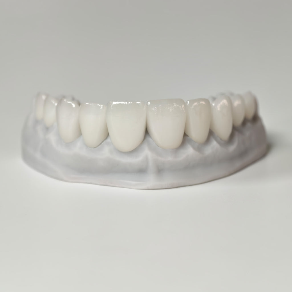 Ultra-Thin Emax Veneer. High Transparency/Translucent, Natural Shade