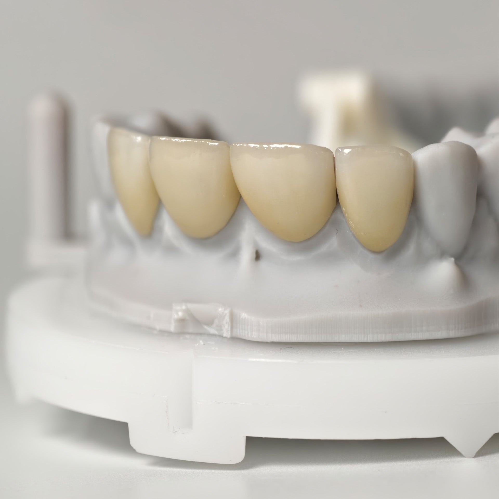 Ultra-Thin Emax Veneer. High Transparency/Translucent, Natural Shade