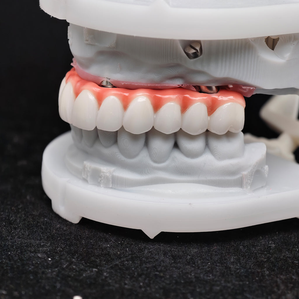 Zirconia-Enamel Hybrid Malo Bridge