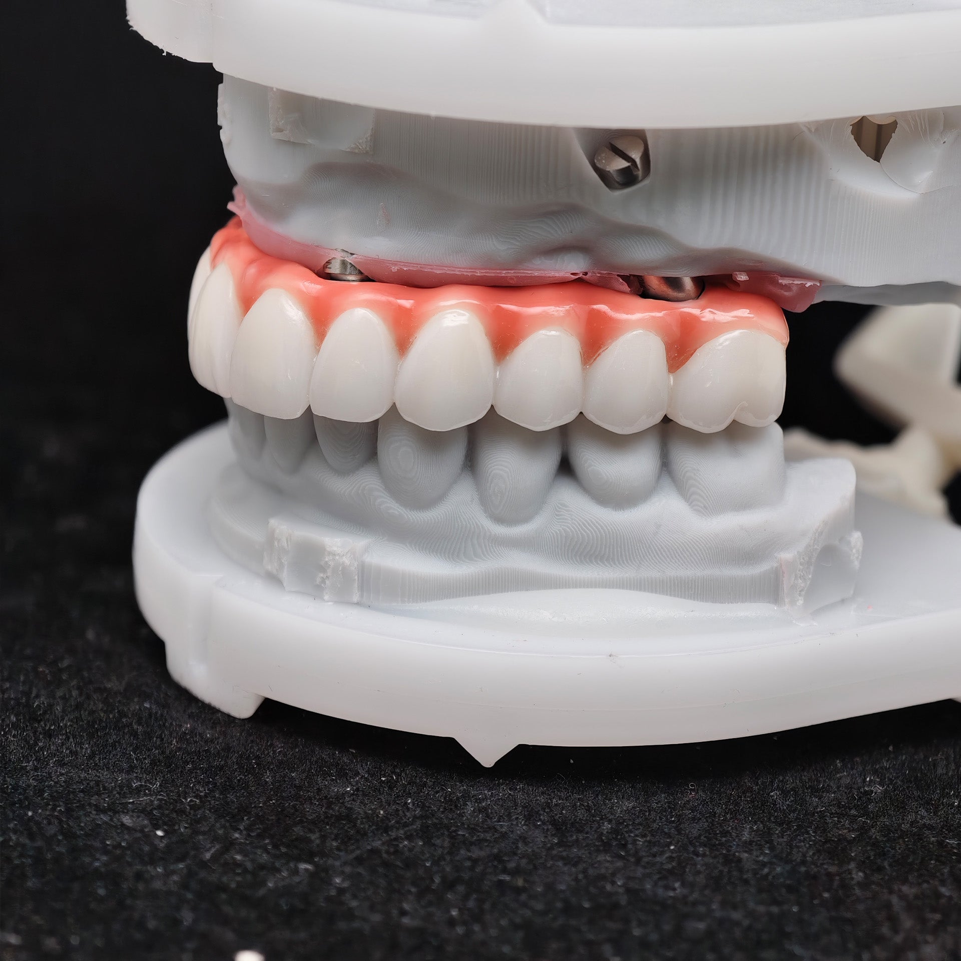 Zirconia-Enamel Hybrid Malo Bridge
