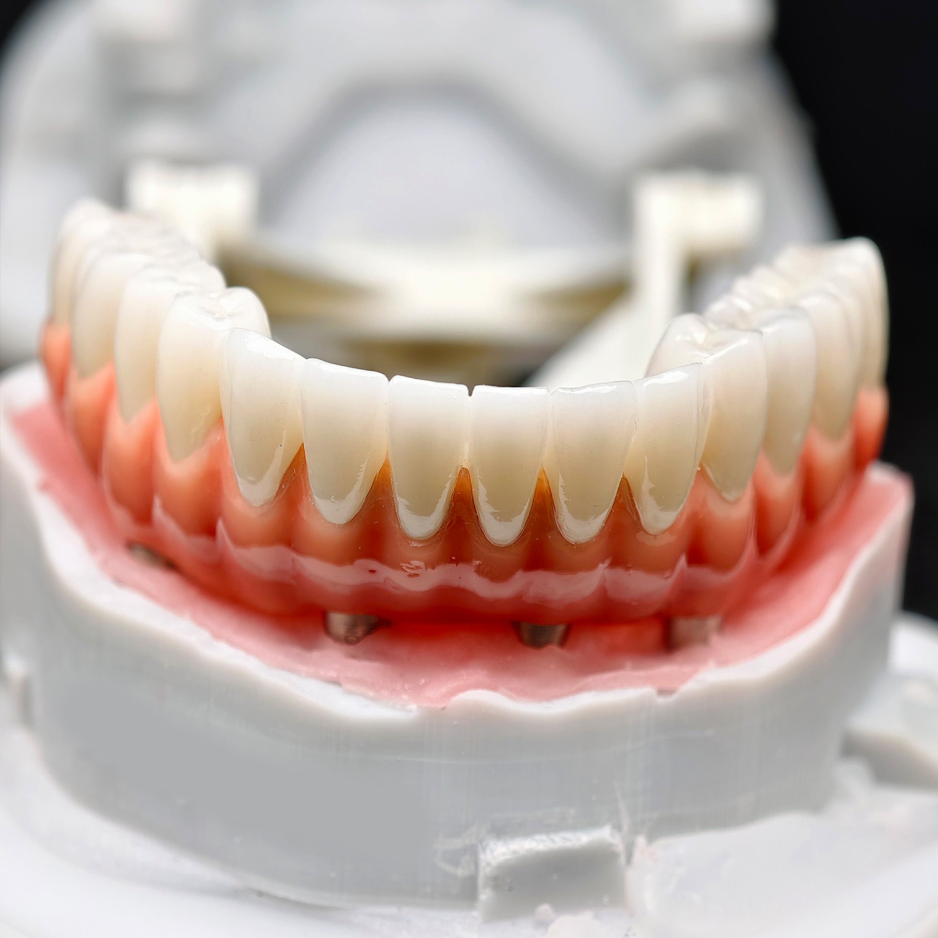 Zirconia-Enamel Hybrid Malo Bridge