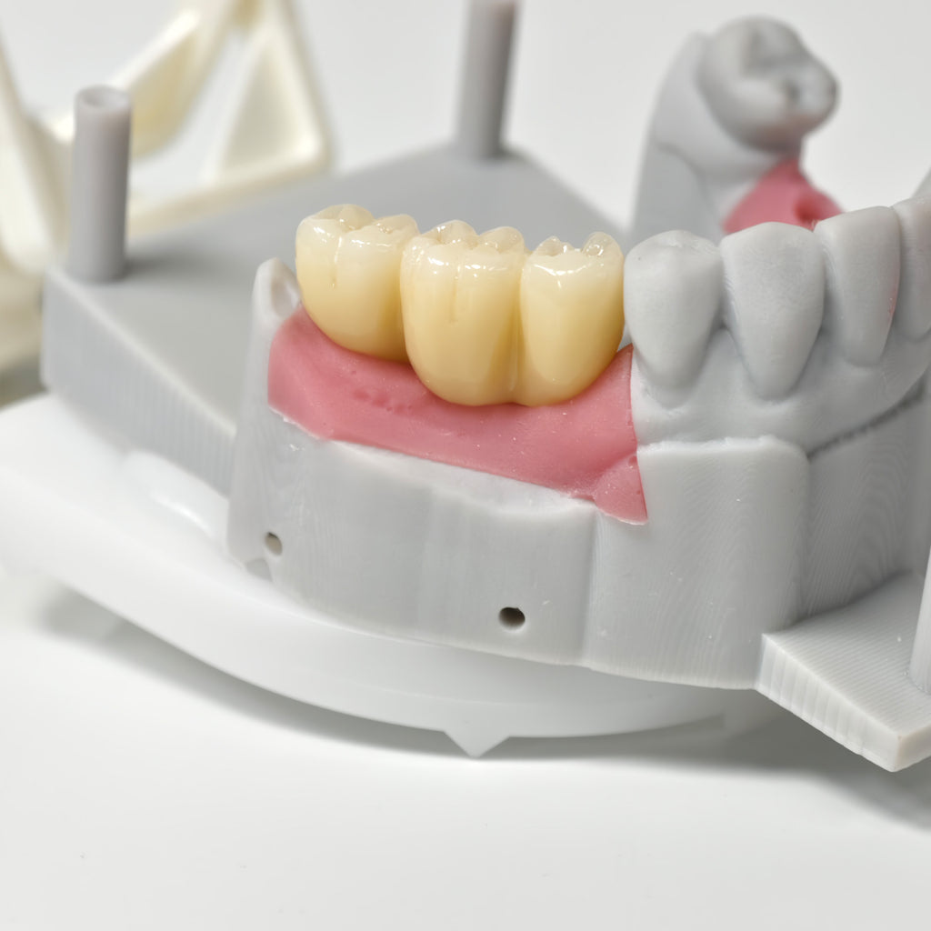 Zirconia Bridges With Screw Retained