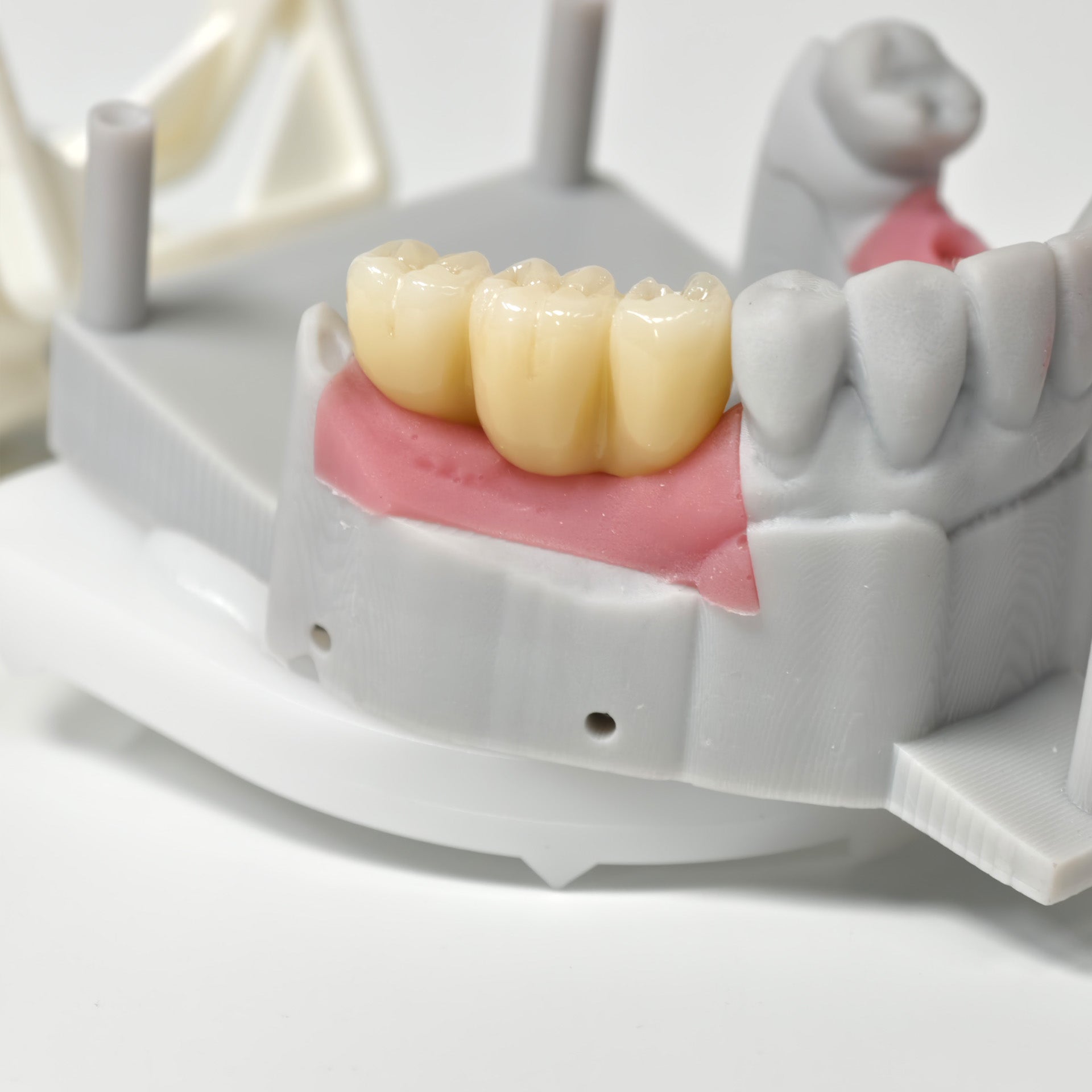 Zirconia Bridges With Screw Retained