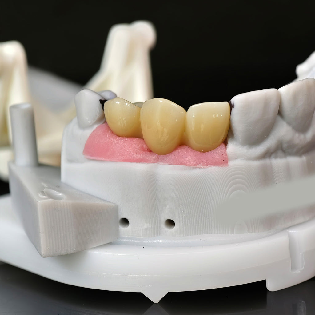 Zirconia Bridge With Ti-Base Screw Retained