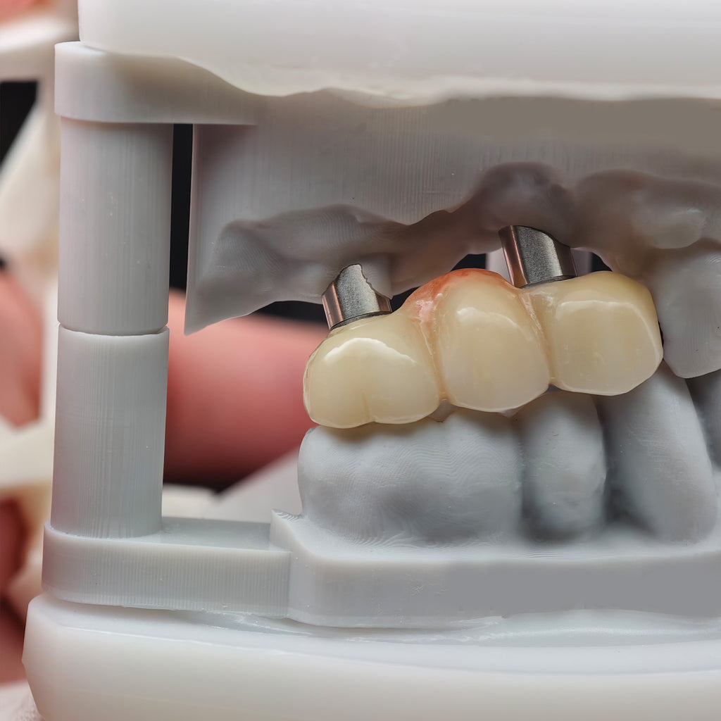 Zirconia Bridge With Ti-Base Screw Retained