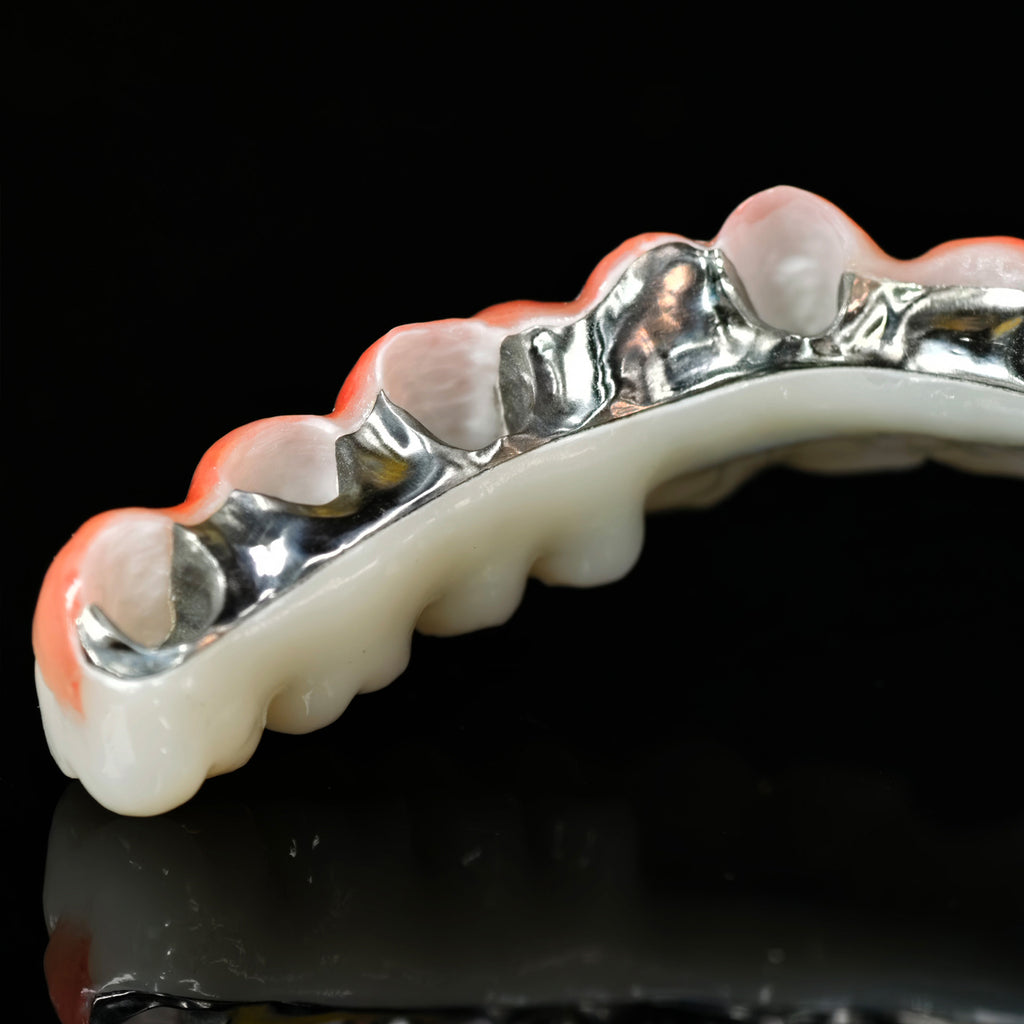 Zirconia Bridge With Cement Retained And Titanium Bar