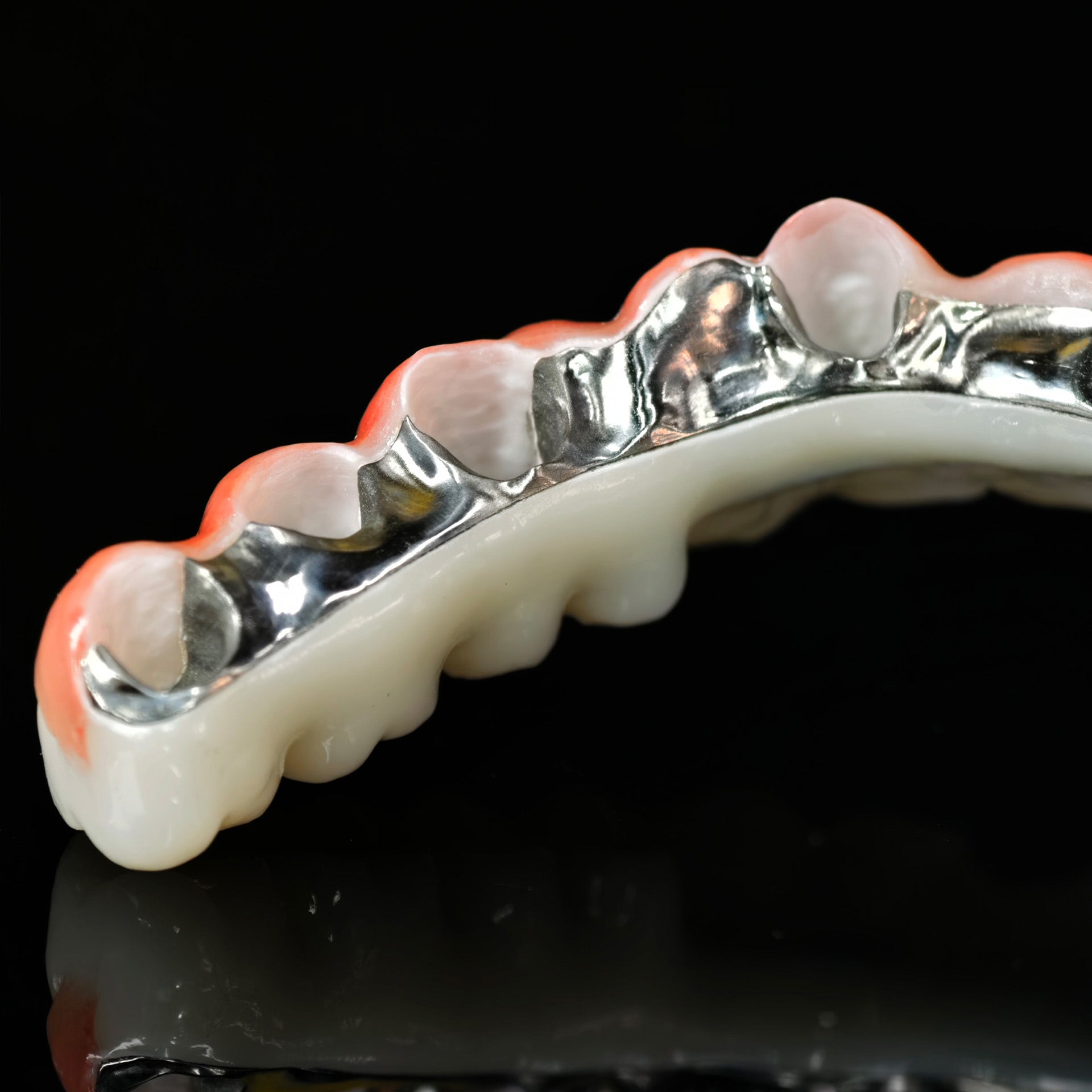 Zirconia Bridge With Cement Retained And Titanium Bar