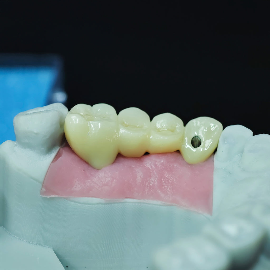 Zirconia Bridge With Screw Retained