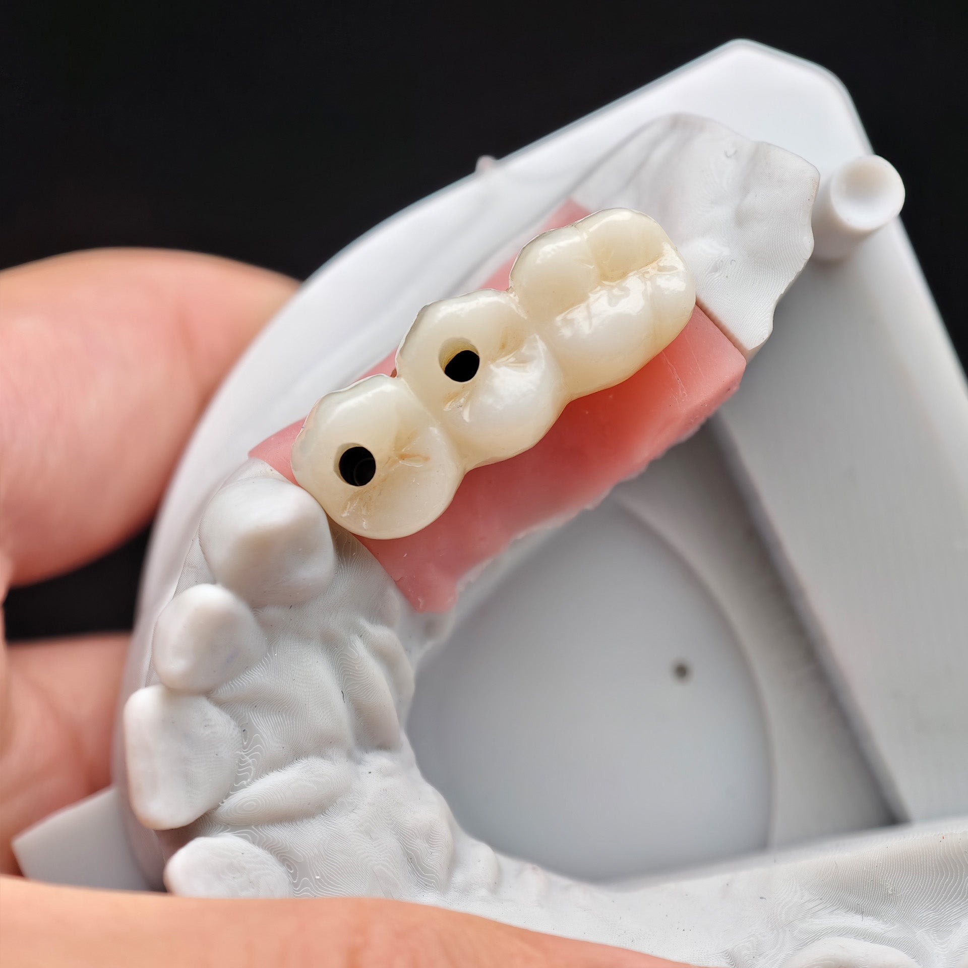 Zirconia Bridge With Screw Retained