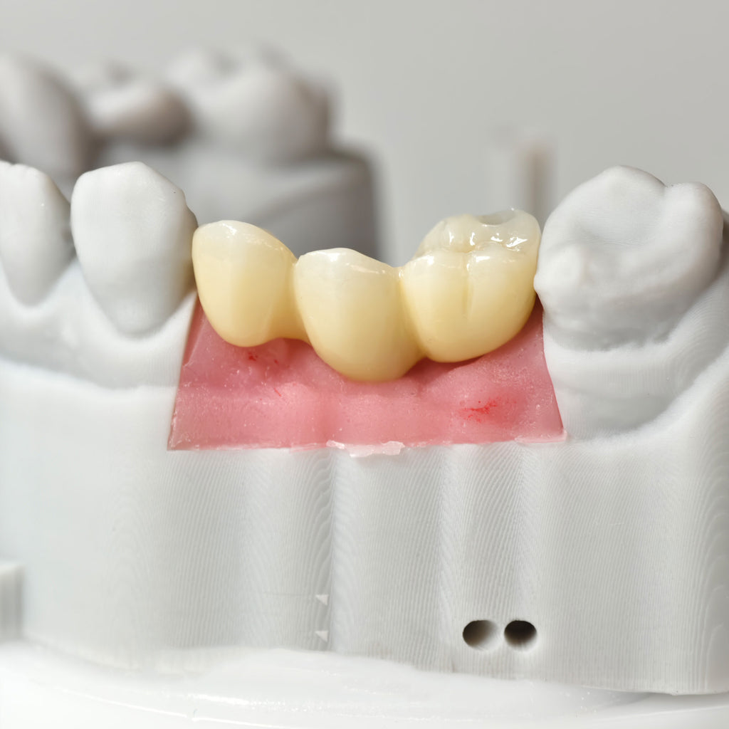 Zirconia Bridgewith Screw Retained