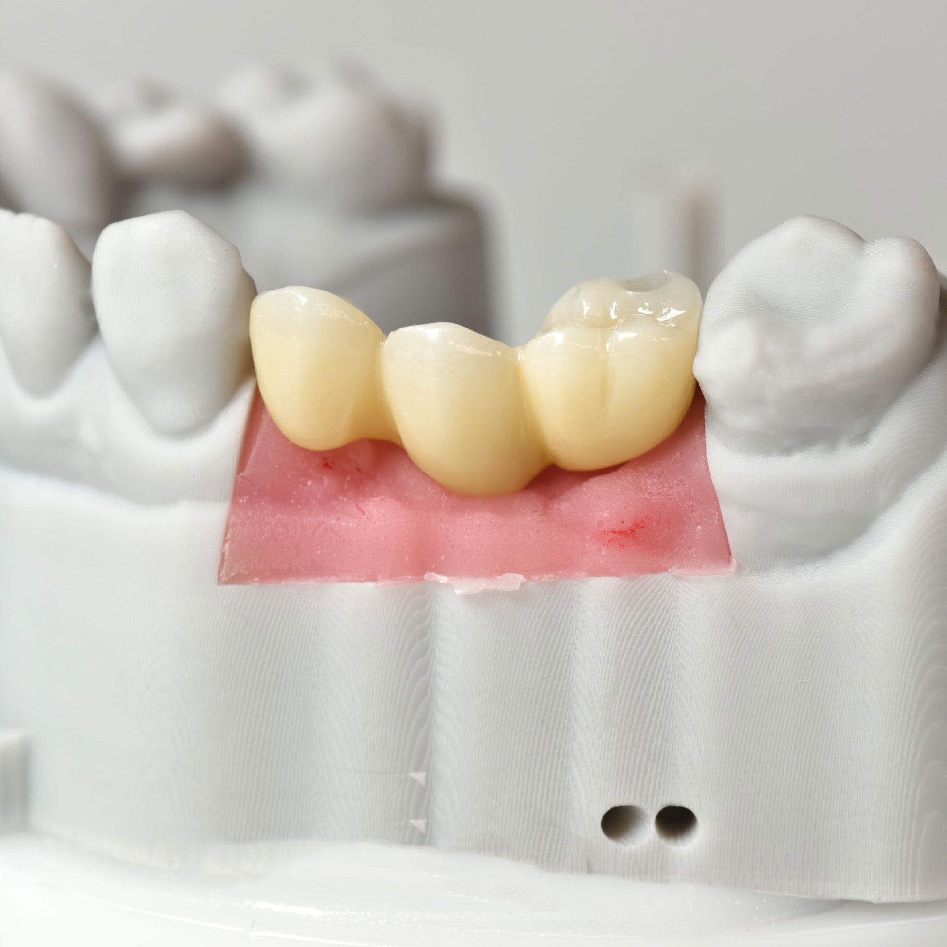 Zirconia Bridgewith Screw Retained