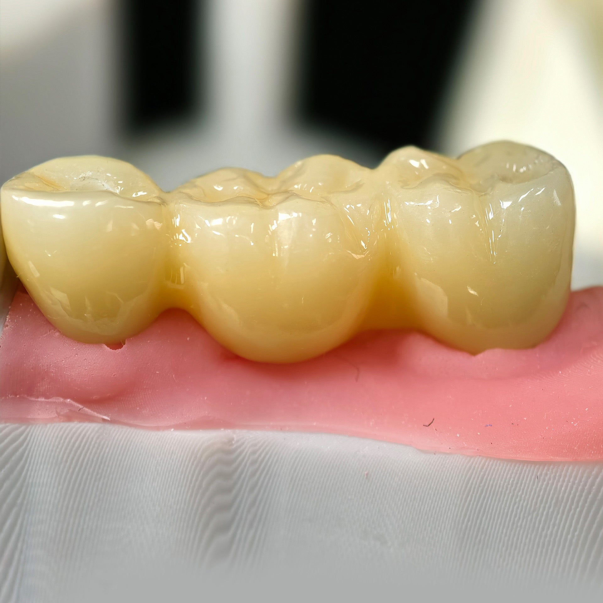 Zirconia Bridge With Screw Retained
