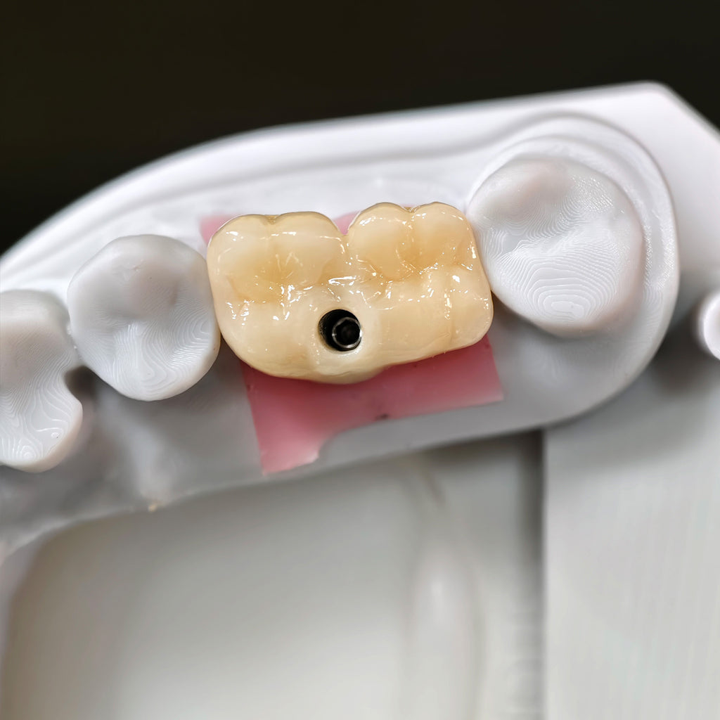Zirconia Bridge With Screw Retained