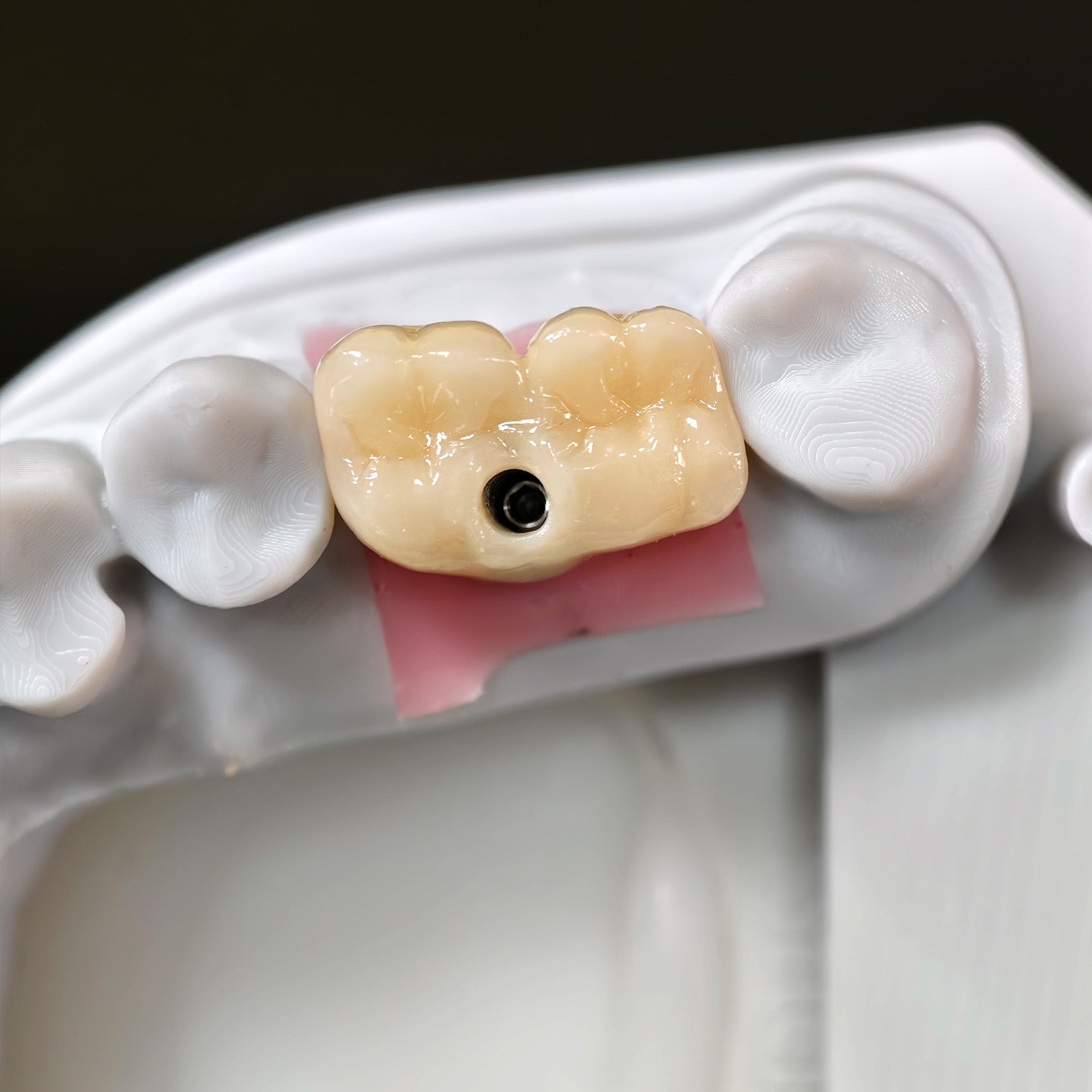 Zirconia Bridge With Screw Retained