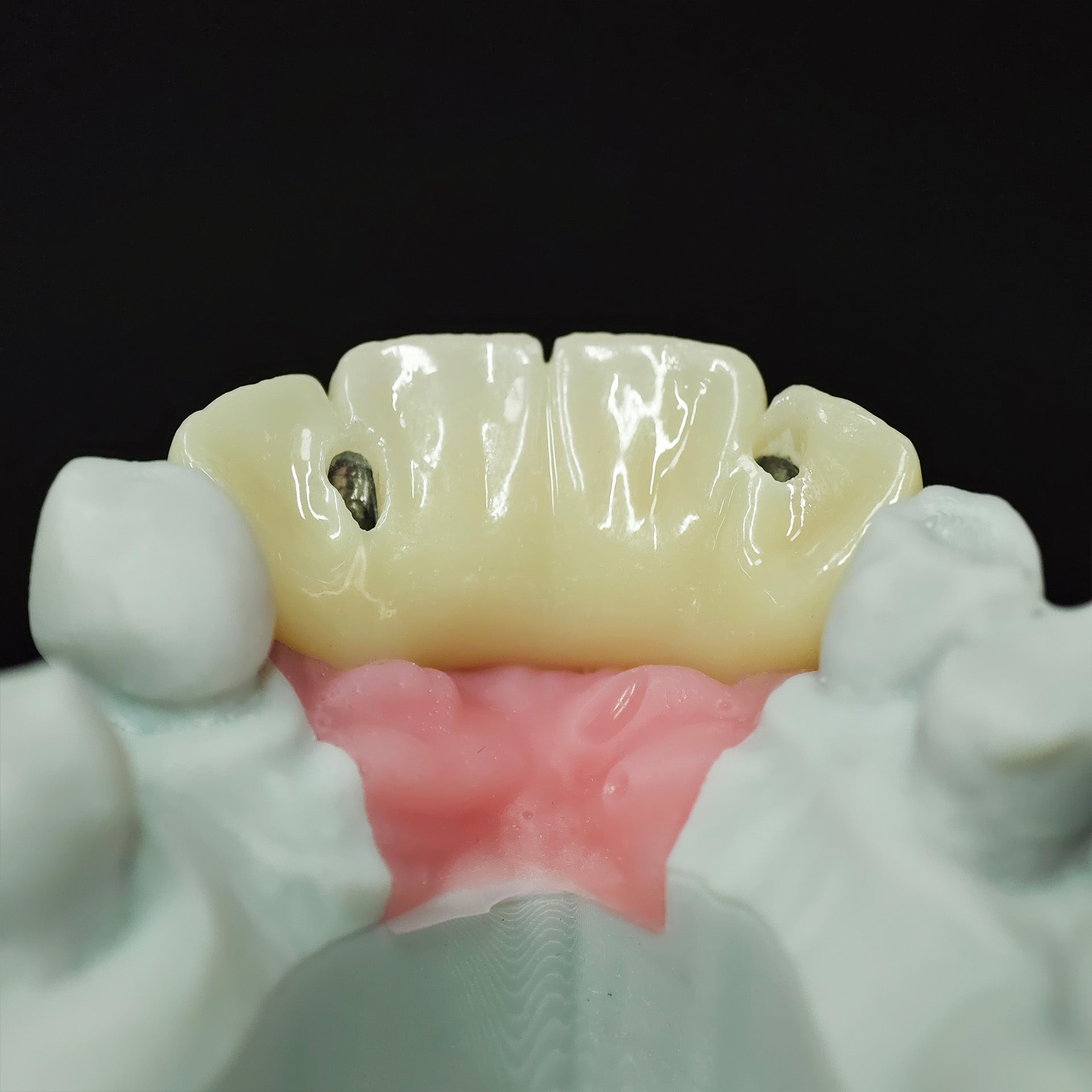 Zirconia Bridge With Screw Retained