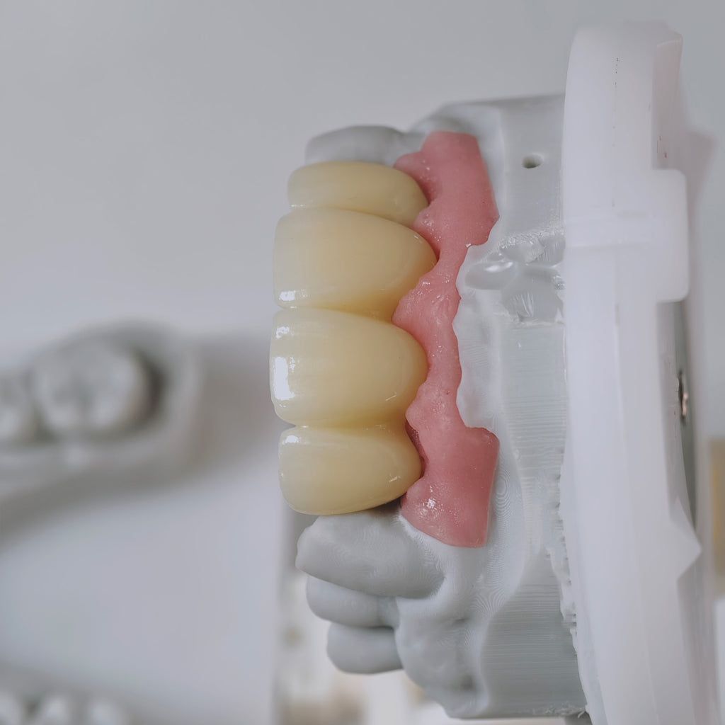 Zirconia Bridge With Screw Retained