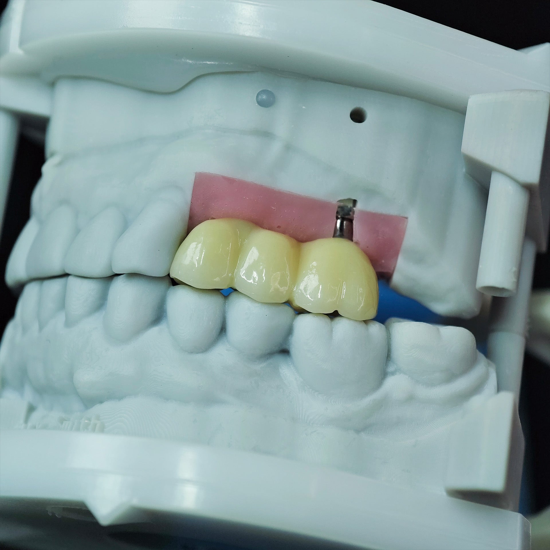 Zirconia Bridge With Screw Retained