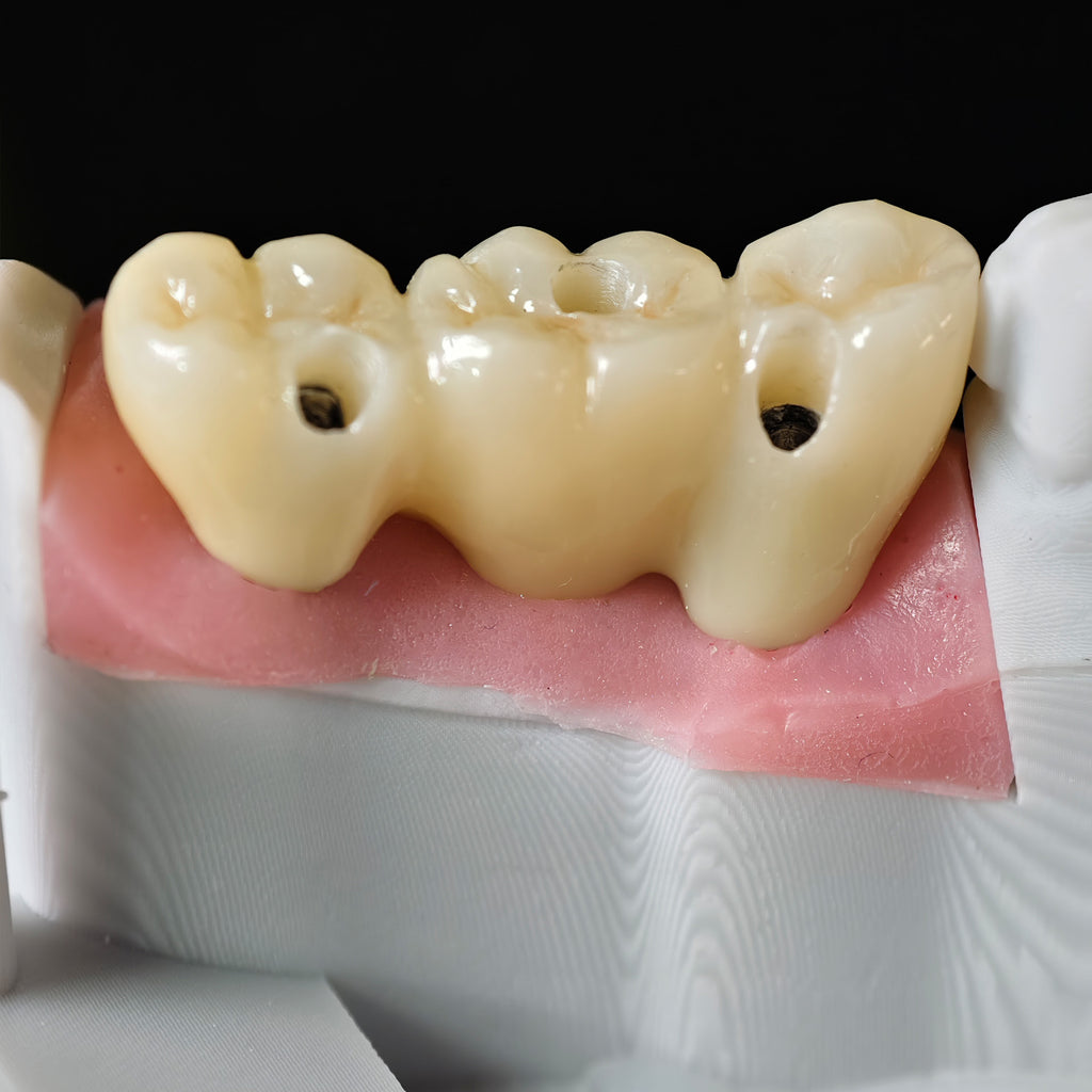 Zirconia Bridge With Screw Retained Gold Plating