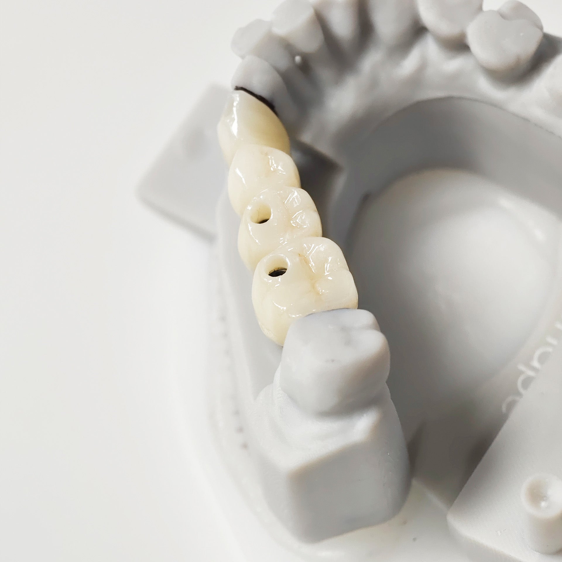 Zirconia Bridge With Ti-Base Screw Retained