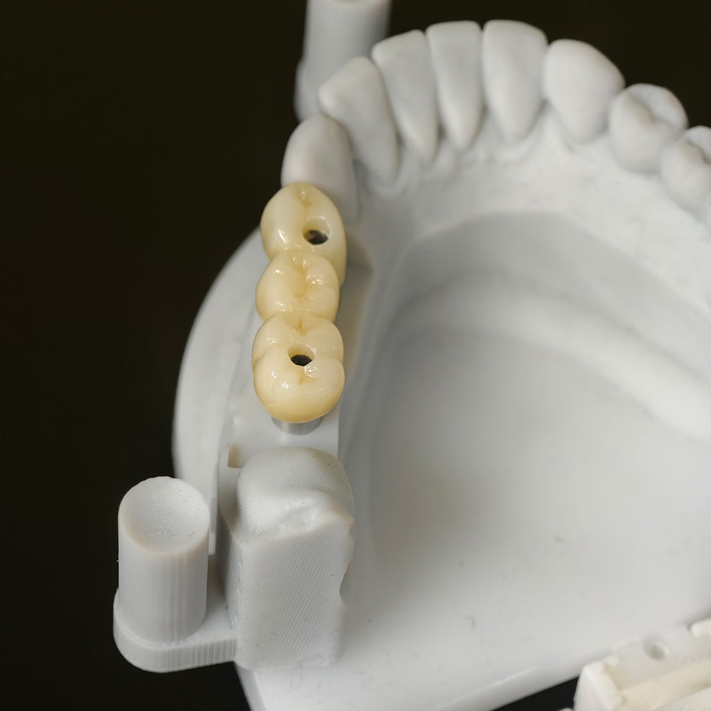 Zirconia Bridge With Ti-Base Screw Retained