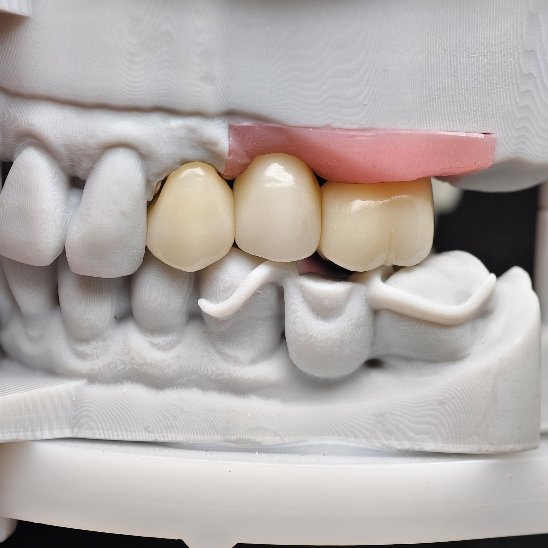 Zirconia Crown And Bridge With Screw Retained