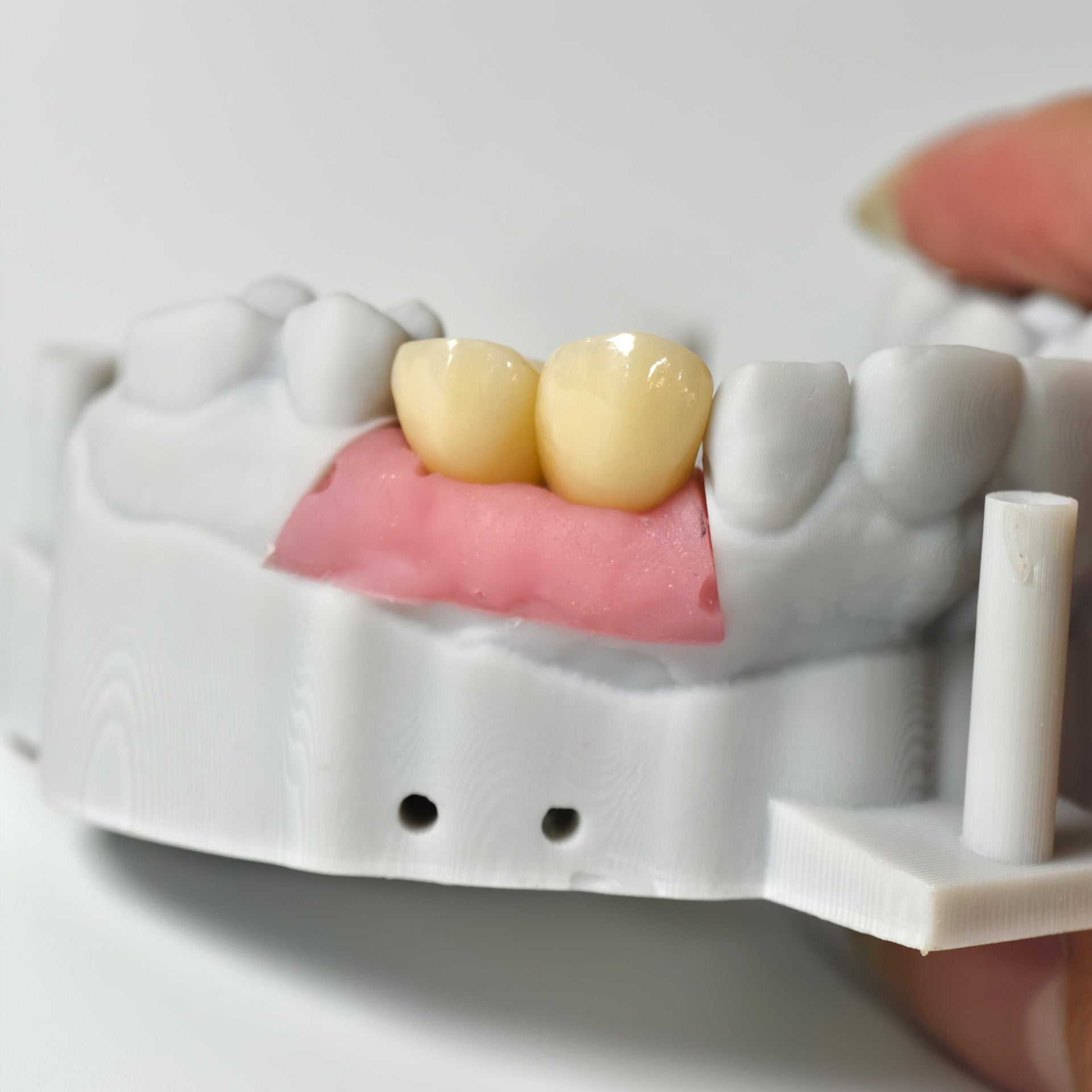 Zirconia Crowns With Gold-Plated Abutment