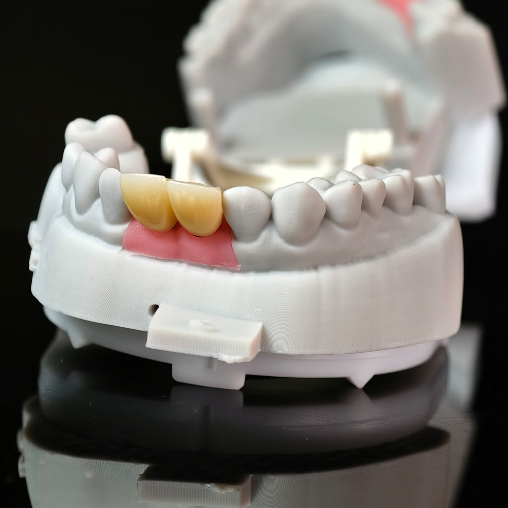 Zirconia Crowns With Gold-Plated Abutment And Implant Seating Guide