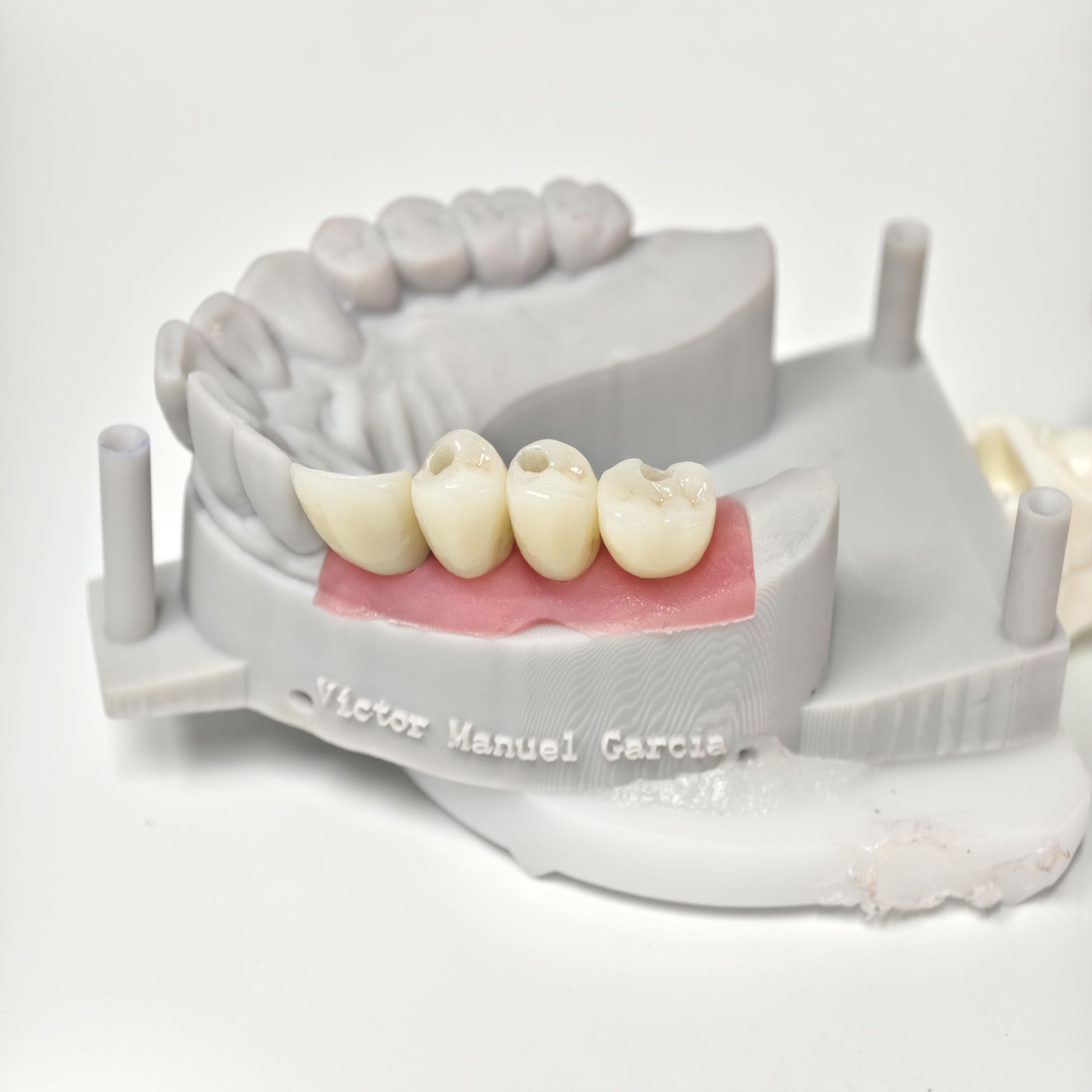 Zirconia Crowns With Screw Retained