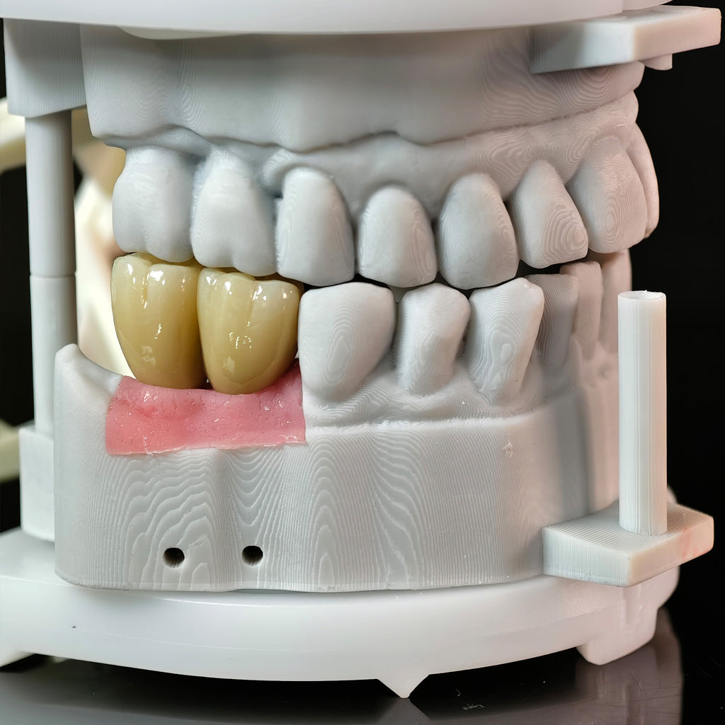 Zirconia Crowns With Screw Retained