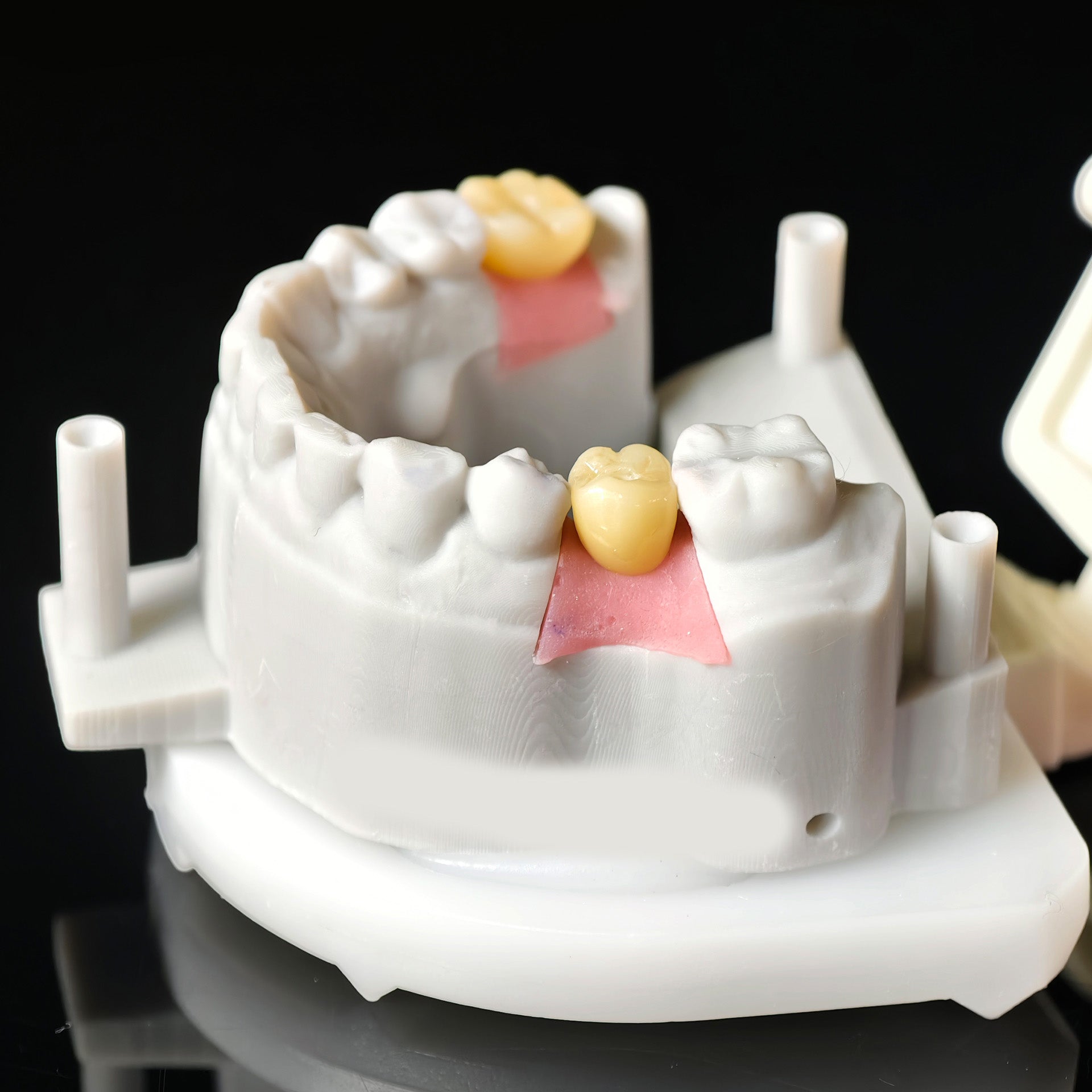 Zirconia Crowns With Screw Retained
