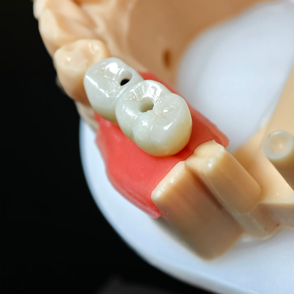 Zirconia Crowns With Screw Retained