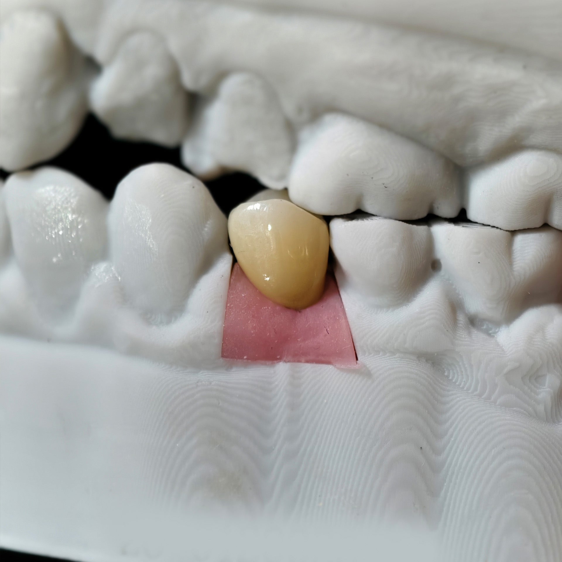 Zirconia Crowns With Screw Retained
