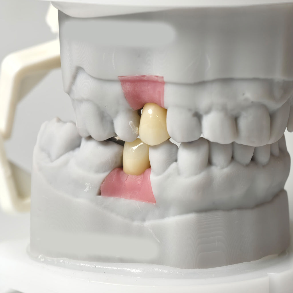 Zirconia Crowns With Screw Retained