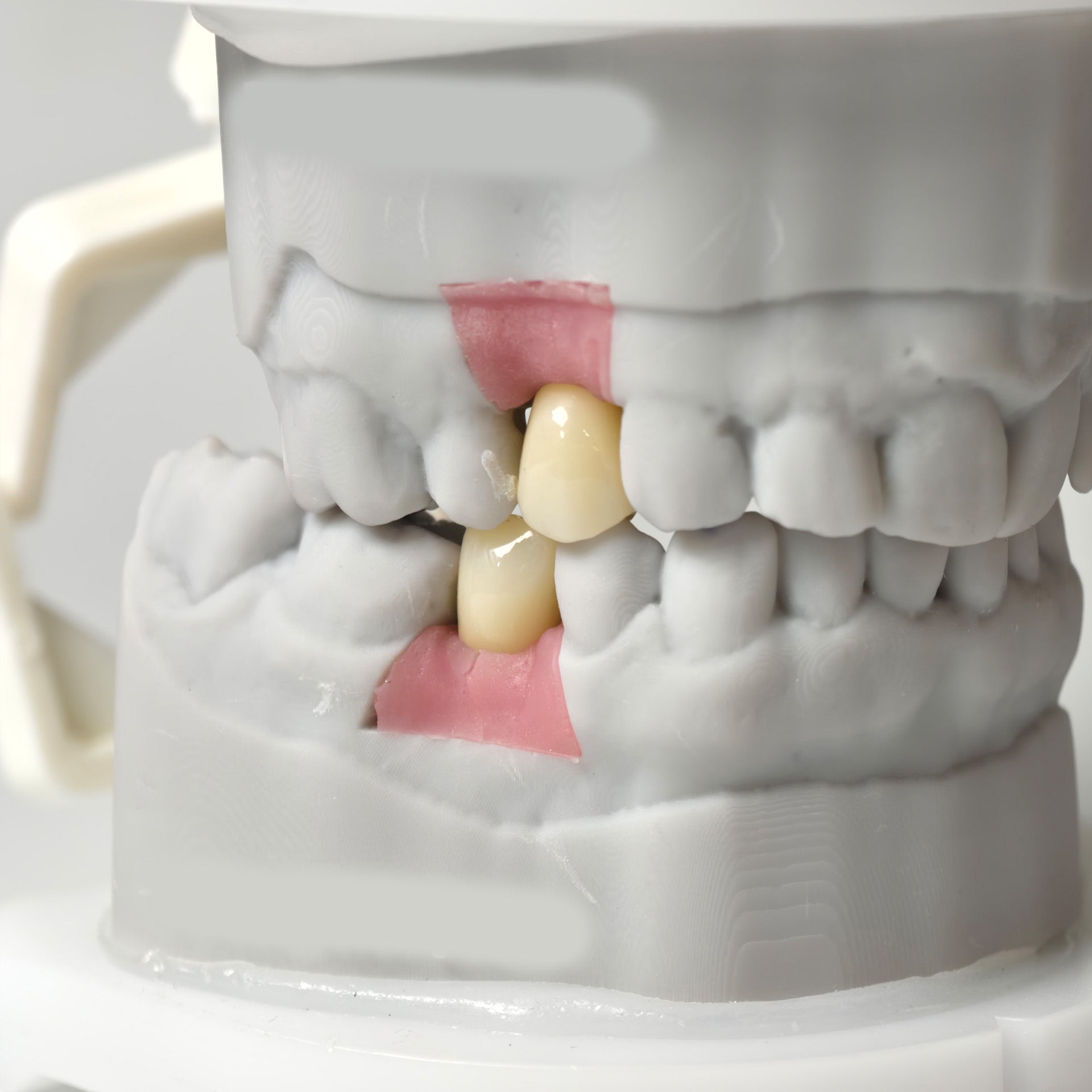 Zirconia Crowns With Screw Retained