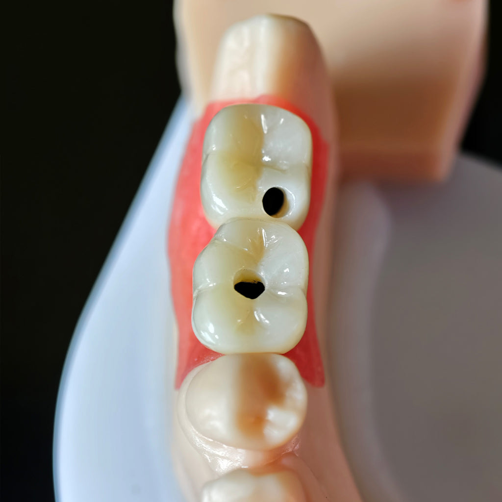 Zirconia Crowns With Screw Retained