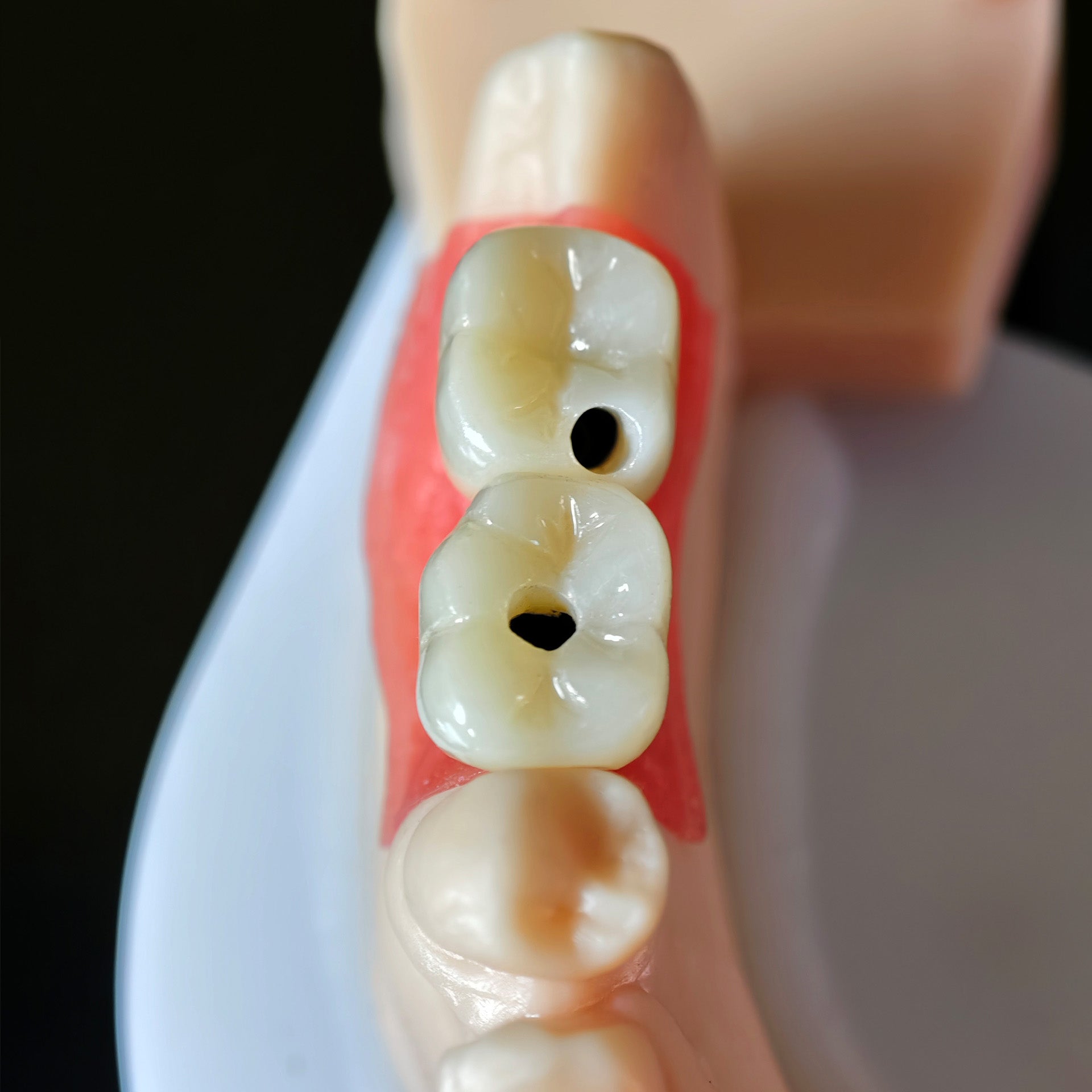 Zirconia Crowns With Screw Retained