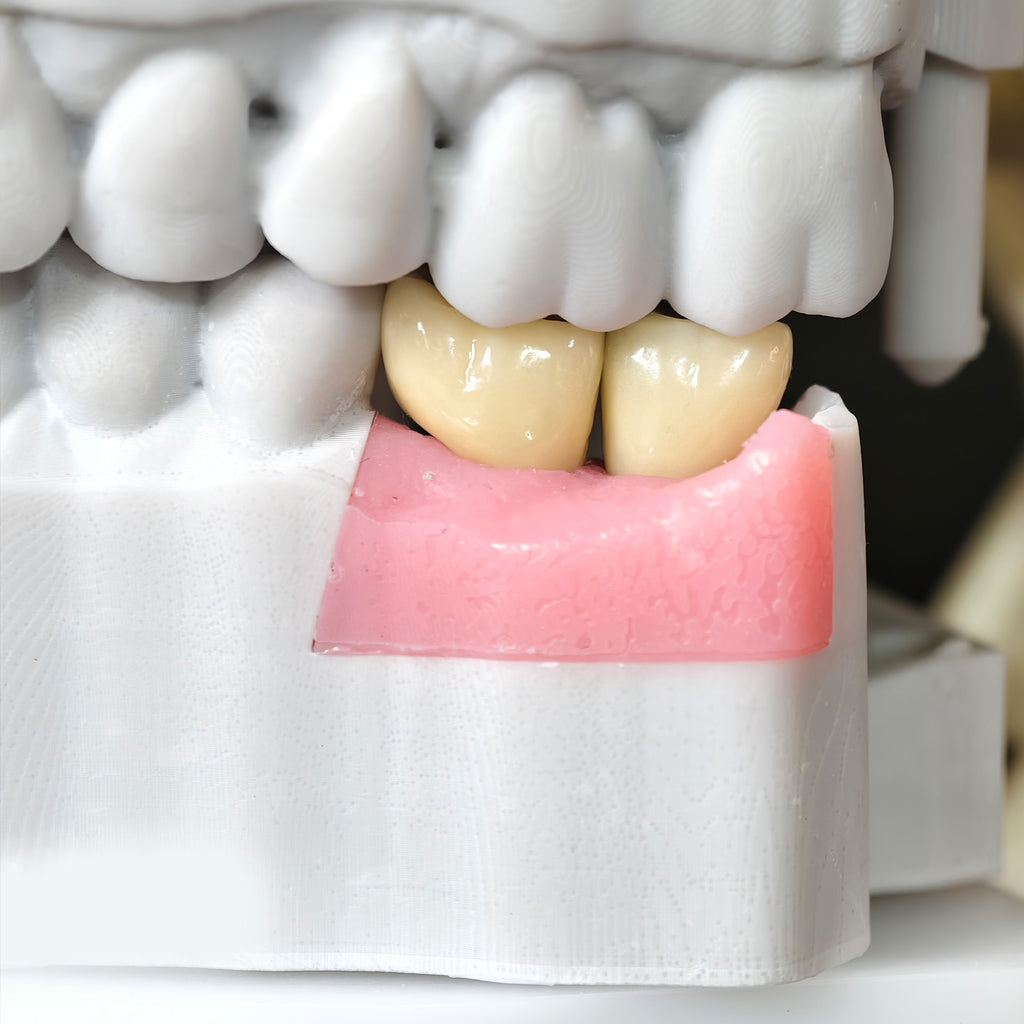 Zirconia Crowns With Screw Retained