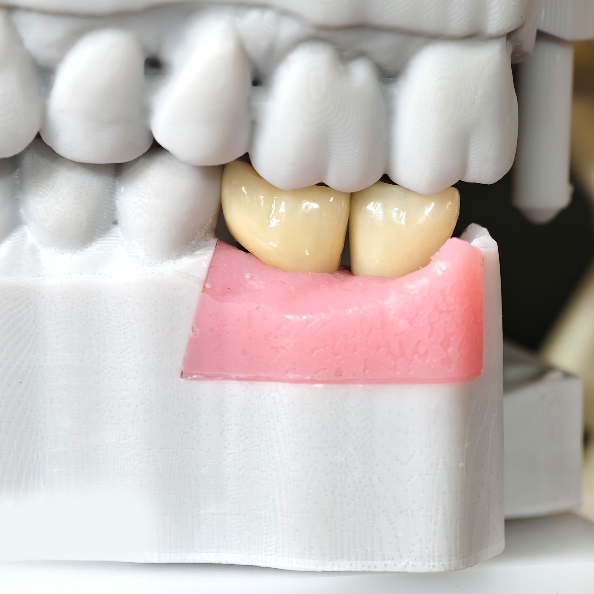 Zirconia Crowns With Screw Retained