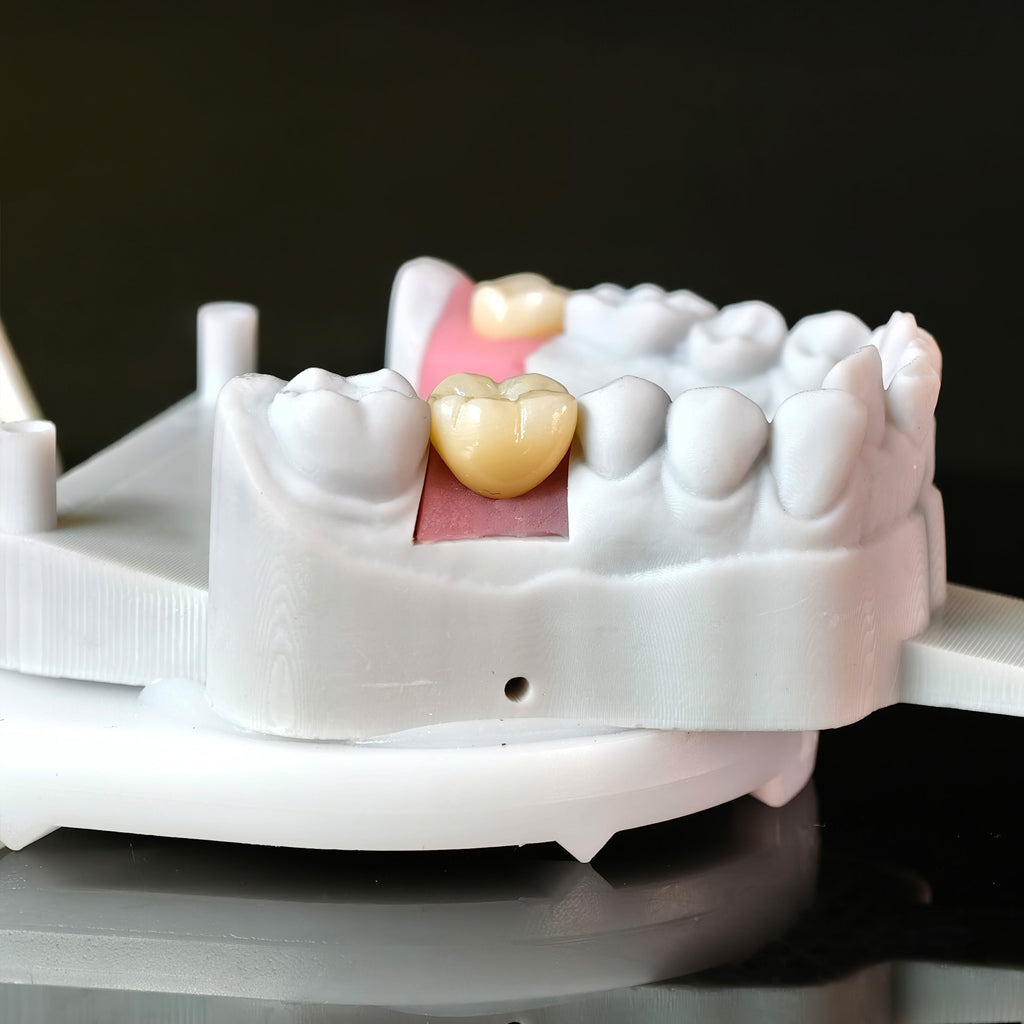Zirconia Crowns With Screw Retained