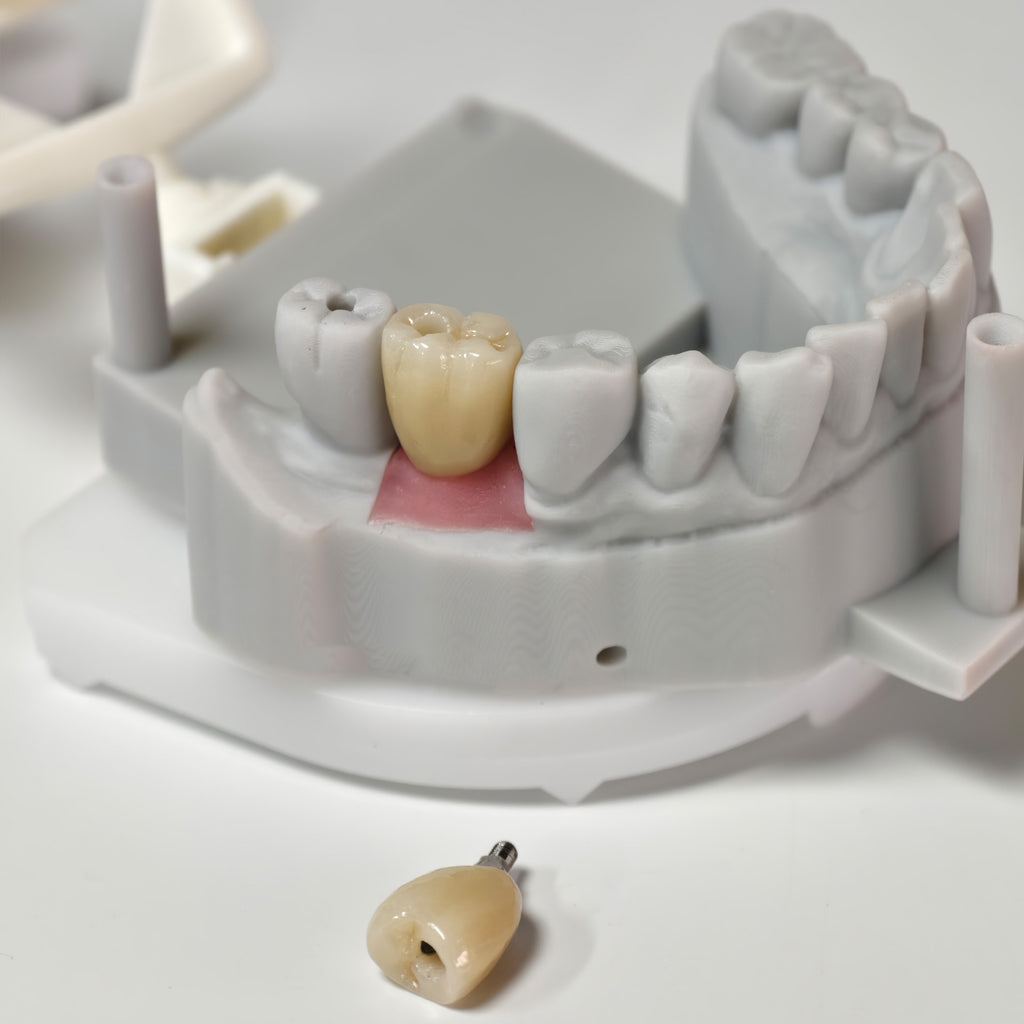 Zirconia Crowns With Screw Retained